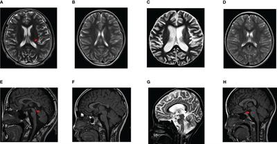 Complex clinical manifestations and new insights in RNA sequencing of children with diabetes and WFS1 variants